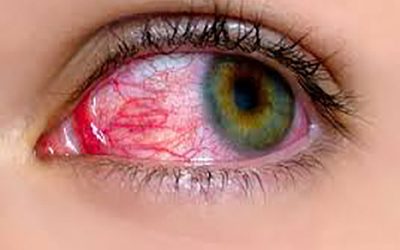 التهاب چشمی چیست و چرا به وجود می آید؟