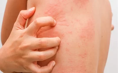 بهترین درمان برای کهیر چیست؟