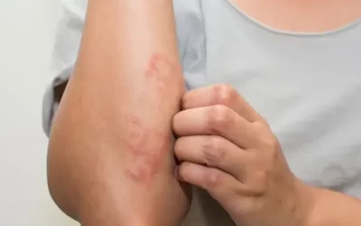 آلرژی به حشرات, علت, علائم و درمان