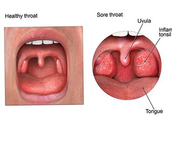 آلرژی گلو چیست؟