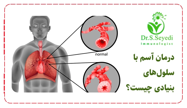 درمان آسم با سلول‌های بنیادی چیست؟