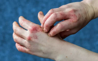 چگونه از اگزمای دست خلاص شویم؟ راهکارهای کاربردی و علمی