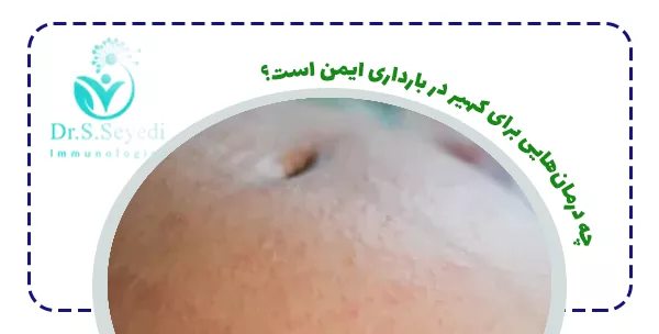 چه درمان‌هایی برای کهیر در بارداری ایمن است؟