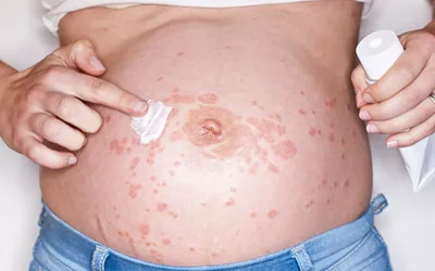 چگونه کهیر در دوران بارداری تشخیص داده می‌شود و چه درمانی دارد؟