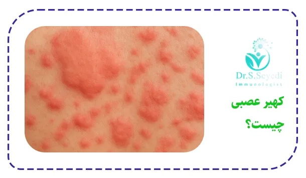 کهیر عصبی چیست؟